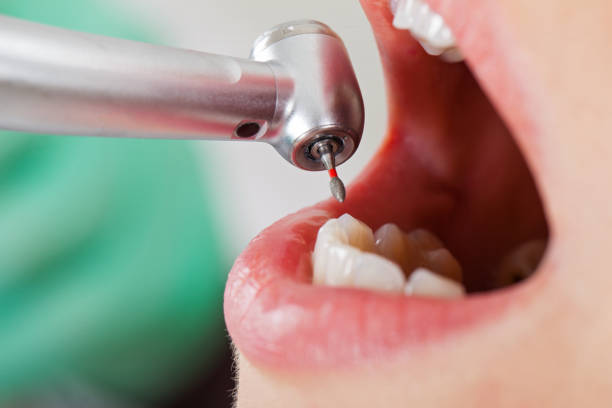 Best Emergency Broken Tooth Repair in Canton, NC